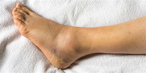 14 Causes of Swollen Ankles, Feet - Puffy Pockets Around Ankles