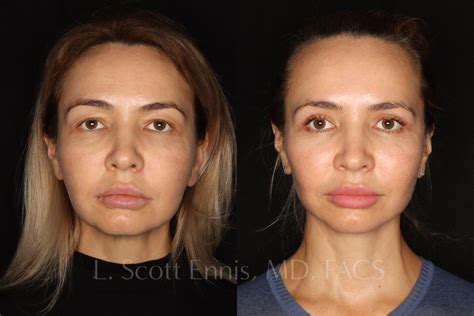 Facelift Before & After Photos by Dr. Ennis in Boca Raton