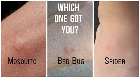 Flea Vs Bed Bug Vs Mosquito Bites - rens dog beds