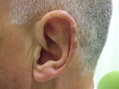 Basal Cell Cancer of the rim of the ear - Dr Vindy Ghura Dermatologist ...