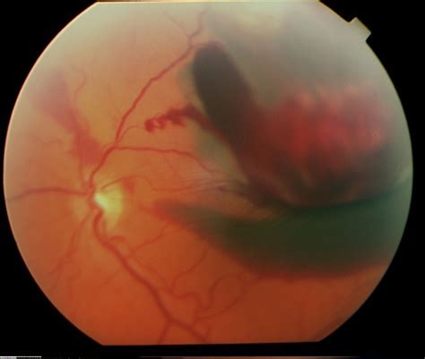 Choroidal Hemorrhage