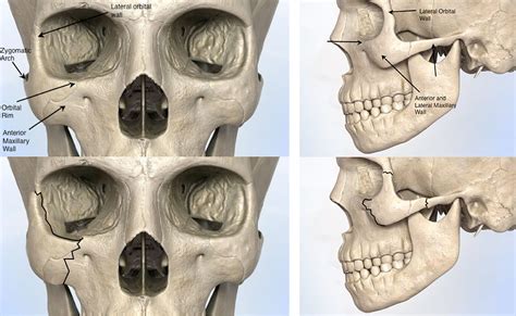 Cheek Fracture - Facial Trauma