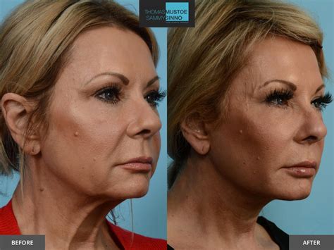 Facelift Before and After Photos Prove Just How Natural Today’s Results ...