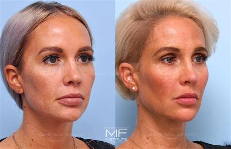 Juvederm Cheeks Before And After Photos