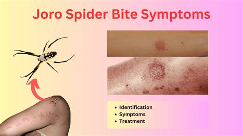 Giant Venomous Joro Spider Bite Symptoms (Treatment 2024)