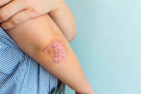 Psoriasis: Diagnosis, Triggers, and Treatment Approaches - Kulani Spa