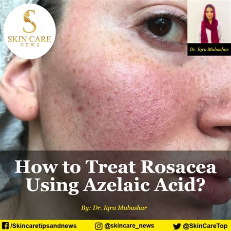 How to Treat Rosacea Using Azelaic Acid?--- Skincare News---