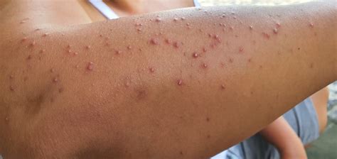 Arm Acne: How to Get Rid of Pimples on Your Arms - Riverchase Dermatology