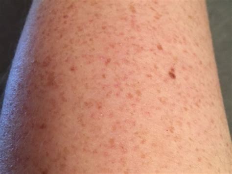 Red Bumps On Upper Arms