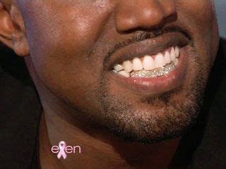 Did Kanye West really have his teeth pulled out and replaced with ...