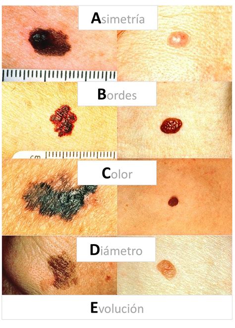 Melanoma Skin Cancer Abcde