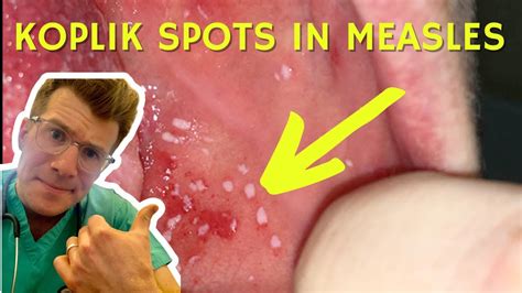 Doctor explains Koplik Spots seen in Measles (with examples) | Doctor O ...