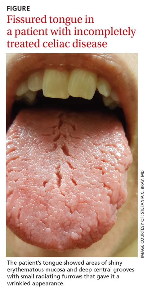 Red patches on the tongue with white borders • history of geographic ...