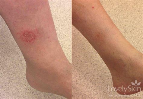 Eczema Before & After Photos | Skin Specialists P.C.