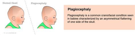 Plagiocephaly - Types, Causes, Symptoms, Complications, Diagnosis ...