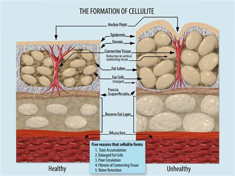 Cellulite - Causes, Symptoms, Prevention & Treatment - SkinPractice