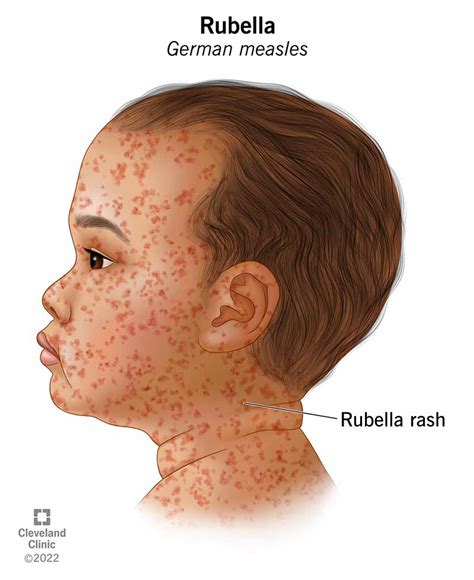 Albums 91+ Pictures What Does The Beginning Of Measles Look Like Superb ...