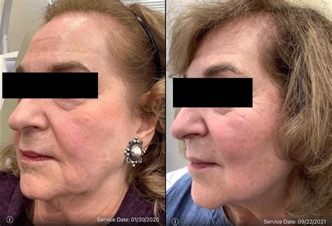 Genius RF Microneedling Before & After Photos Patient 42 | Washington ...