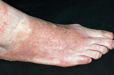 Infected Eczema On The Foot Photograph by Dr P. Marazzi/science Photo ...