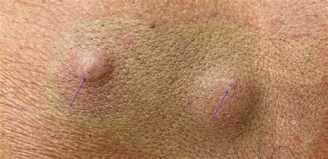 Hard Sebaceous Cyst Removal and Surgery | Nexus Surgical