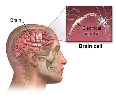 Epilepsy - KellyannSunny