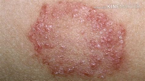 Fungal Skin Rash Treatment