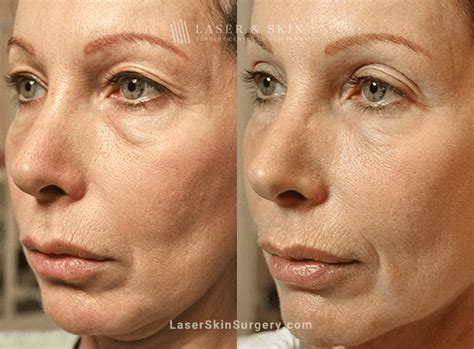 Laser Skin Tightening: What Is It and How Long Does It Last? - Laser NY