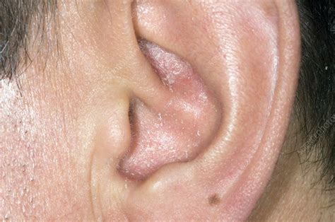 Plaque Psoriasis Ear