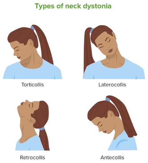 Types of neck dystonia - MEDizzy