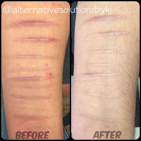 Skin needling-scar removal before & after by Krystin Jones | Skin ...