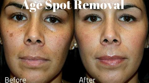 Age Spots On Face Removal