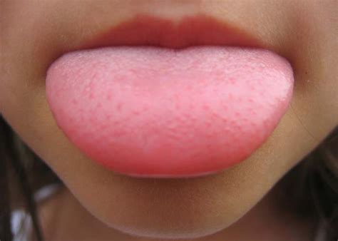 Swollen or Inflamed Taste Buds on Tongue : Causes and Remedies ...