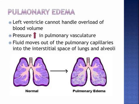 Pulmonary edema