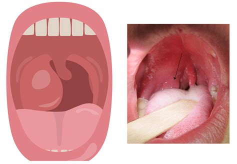 The Tonsils (Waldeyer's Ring) - Lingual - Pharyngeal - Palatine - Tubal ...