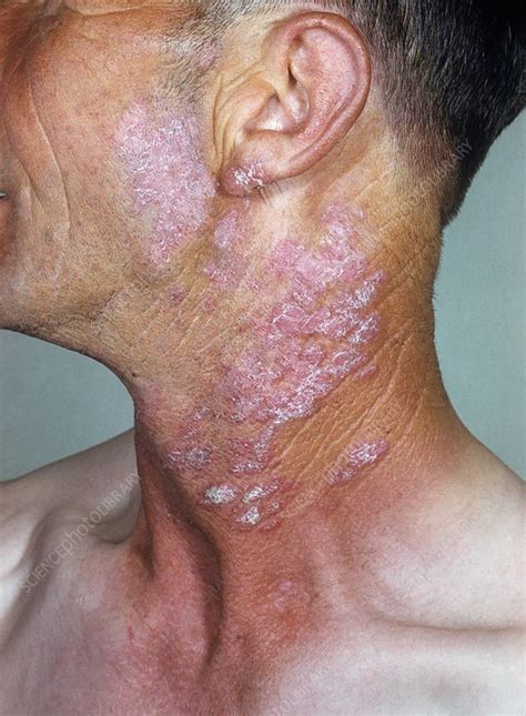 Lupus erythematosus on the neck - Stock Image - C013/1026 - Science ...