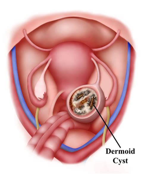 How Big Is An Ovary