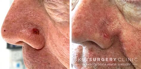 Basal Cell Carcinoma BCC Skin Cancer Removal Leeds Bradford Before and ...