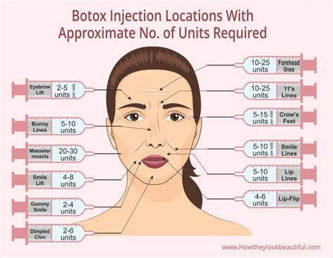 Where on Your Face Can You Get Botox Injected? (With Units)