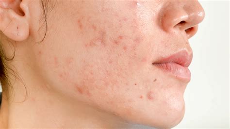 How to Get Rid of Acne Scars: Topical Treatments, Surgery, & More - GoodRx