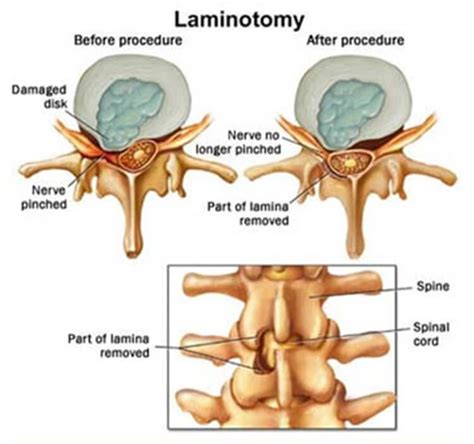 Laminotomy Vs Laminectomy - Which One to Choose?