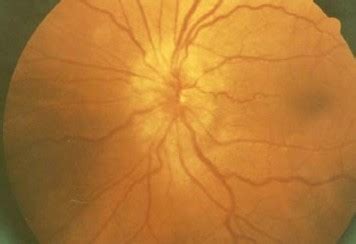 Papilledema Pictures, Symptoms, Causes, Treatment