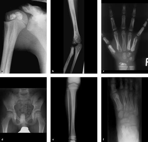 6.1 Upper Arm | Radiology Key