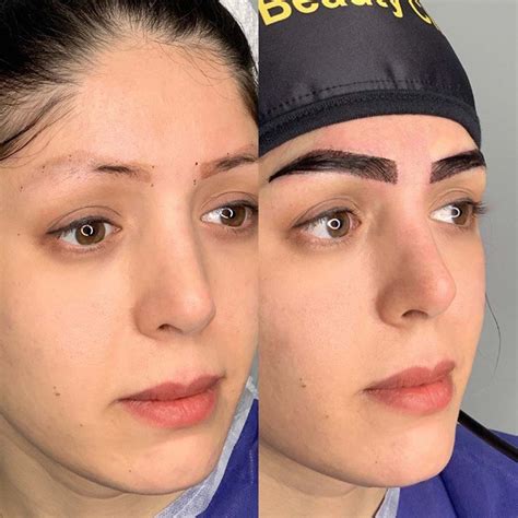 Eyebrow Transplant Surgery - Results, Risks, Cost