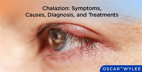 Chalazion: Symptoms, Causes, Diagnosis, and Treatments