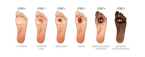 What is The Wagner Scale of Diabetic Foot Ulcer Stages?