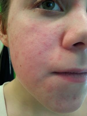 How To Get Rid Of Allergic Reaction On Face - Aimsnow7