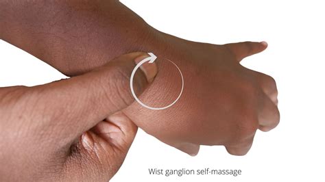 These 3 Easy Ganglion Cyst Wrist Exercises will Remove Lump Without Surgery