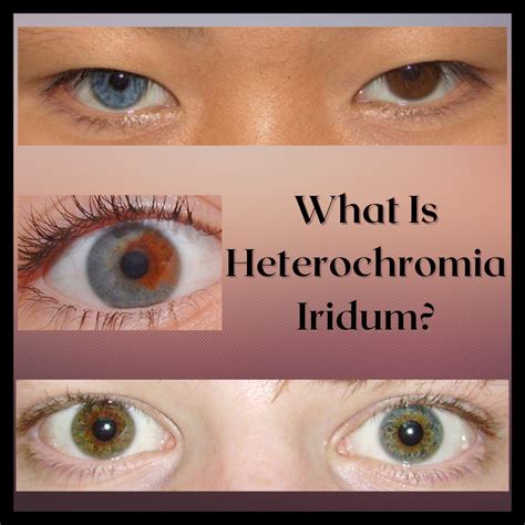 Heterochromia Iridum: People With Two Different Colored Eyes - Owlcation