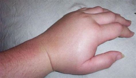 Suffer from swollen hands when exercising? Here's why.