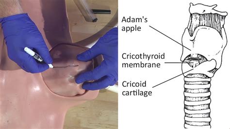 Emergency Needle Cricothyrotomy Procedure Explained - YouTube